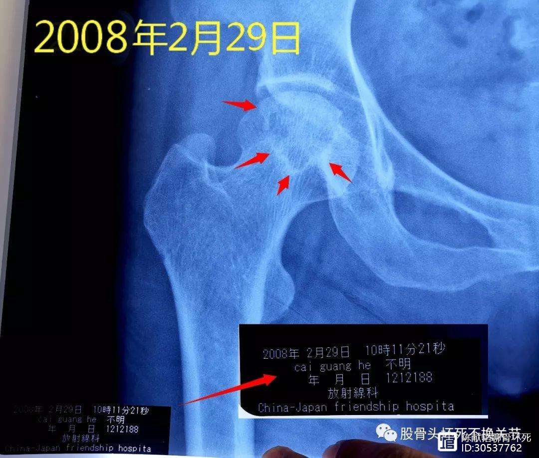 蚌埠人工骨头医保报销多少(人工骨头医保报销多少比例)
