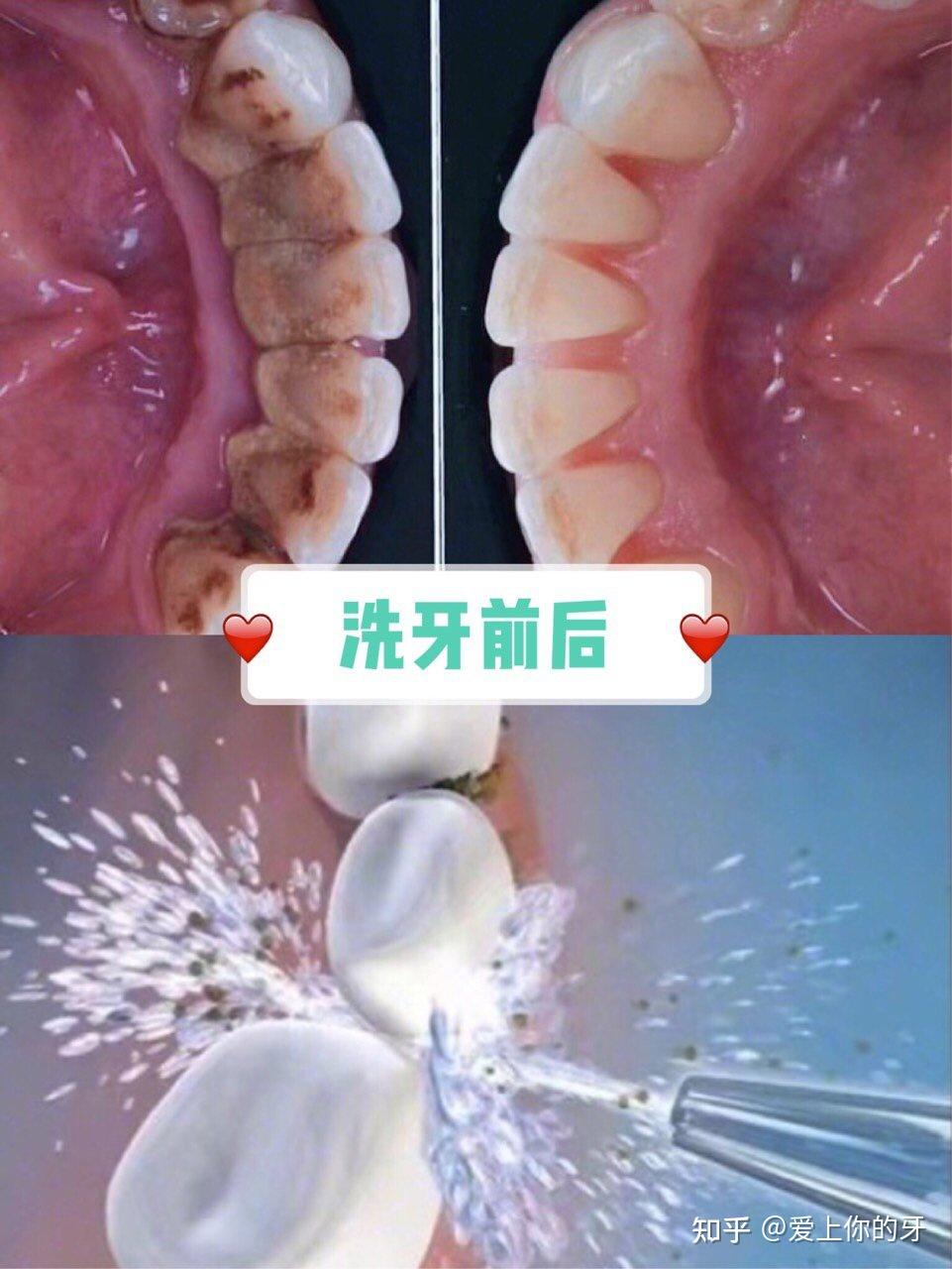 蚌埠洗牙可以用医保吗(洗牙可以用医保吗,报销比例多少)